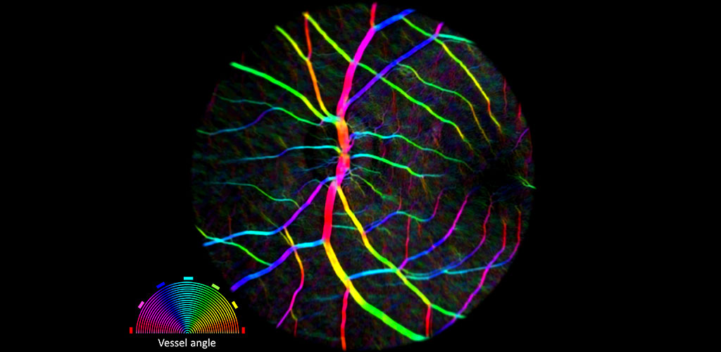 color-coded orientation map of retinal blood vessels in a fundus picture. Each color shows a unique orientation/angle of a vessel