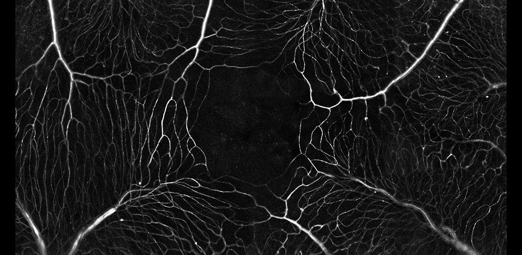 photo of capillaries of the retina