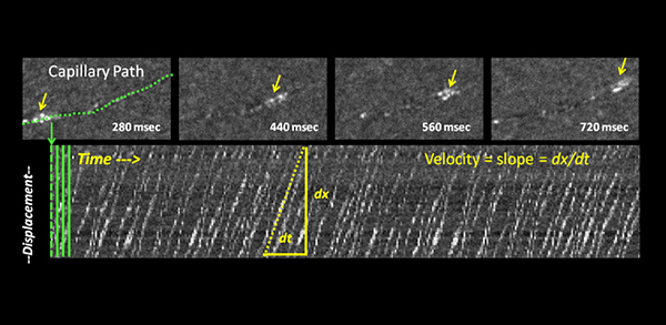In vivo space-time images showing automated measurement of capillary blood velocity, along with snapshots of exemplary cartesian images showing a single moving blood cell