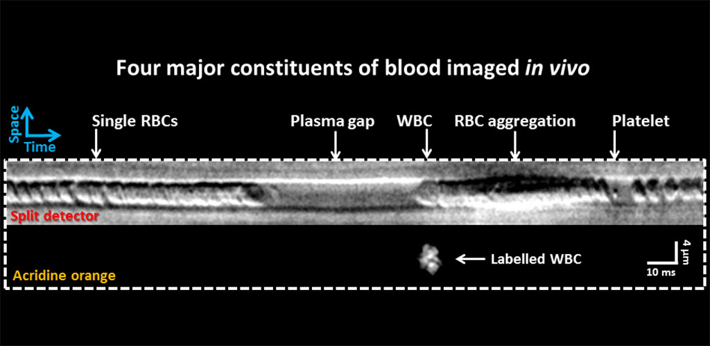 In vivo space-time image of a capillary showing 4 major constituents of blood including white blood cells, red blood cells, platelets, and plasma.