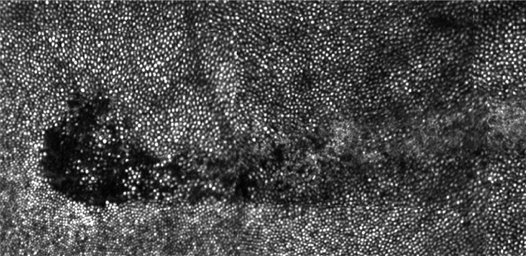 Patchy loss of photoreceptors colocalized with RPE disruption